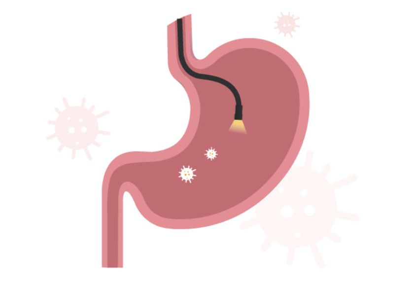 위암 검진 이미지