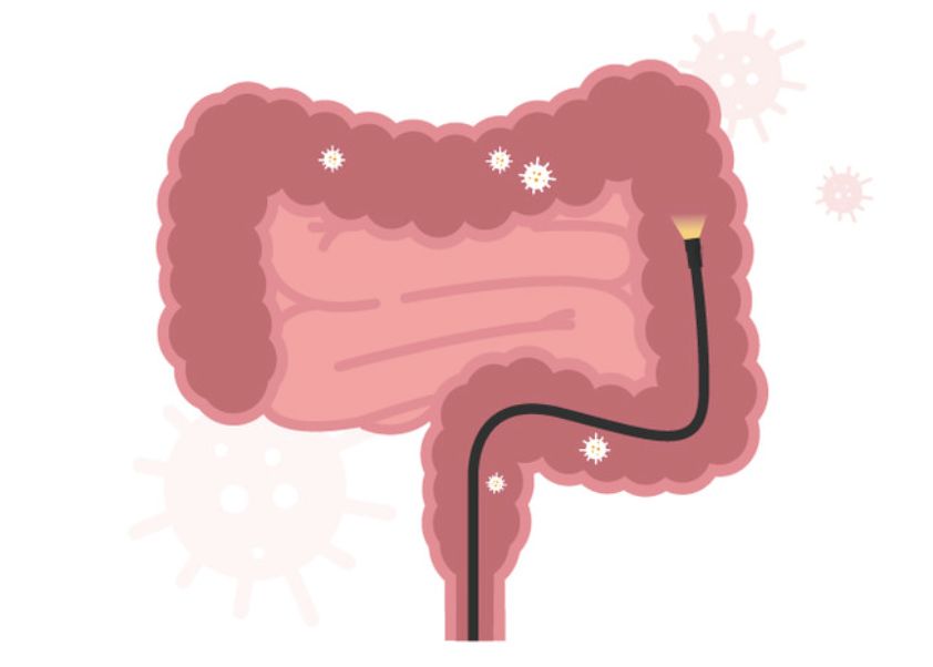 대장암 검진 이미지